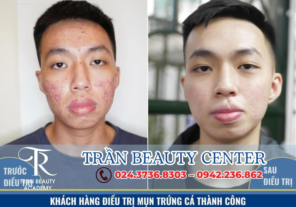 Điều trị mụn là dịch vụ tiếp theo không thể thiếu tại Trần Beauty Center.
