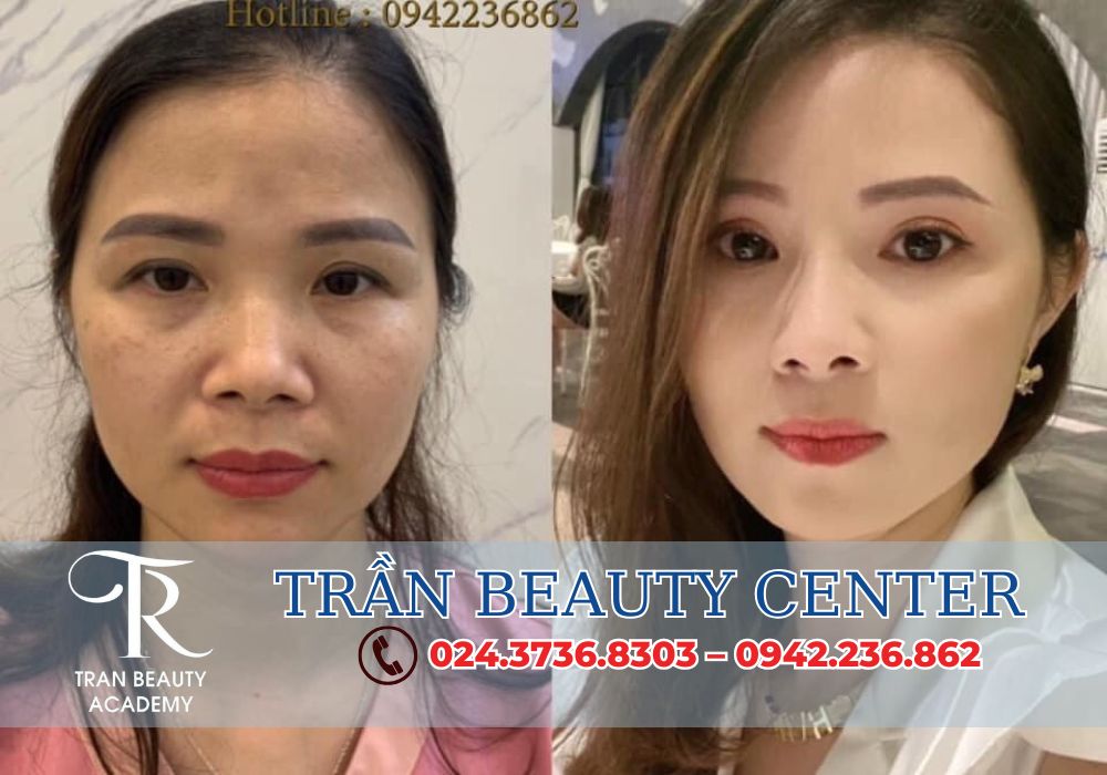 Độn cằm Vline là một phương pháp phẫu thuật thẩm mỹ để tạo hình cằm thon gọn, sắc nét theo dáng Vline, một xu hướng làm đẹp đang được yêu thích trên toàn thế giới, đặc biệt là ở các quốc gia châu Á.