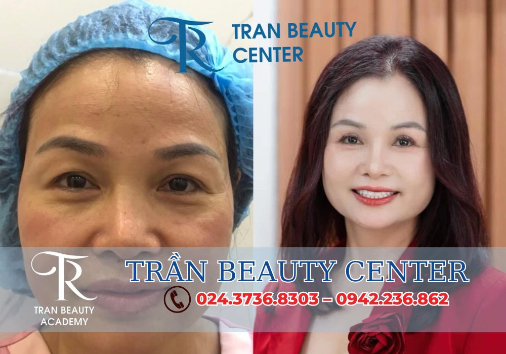 Cắt mí mắt và cắt bọng mắt chính là giải pháp hoàn hảo để khôi phục lại vẻ đẹp tự nhiên, mang đến cho bạn đôi mắt sáng rõ, trẻ trung và cuốn hút.