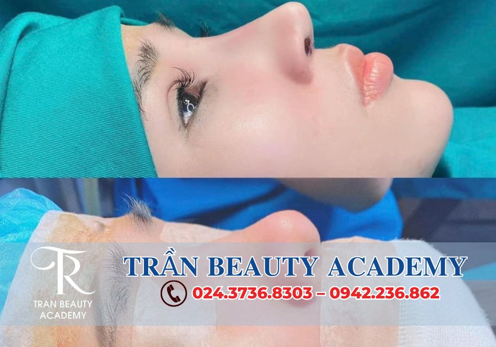 Hãy đến với TRẦN BEAUTY ACADEMY để được tư vấn miễn phí và thực hiện nâng mũi Pureform – giúp bạn sở hữu chiếc mũi thanh thoát và tự nhiên như mong đợi!